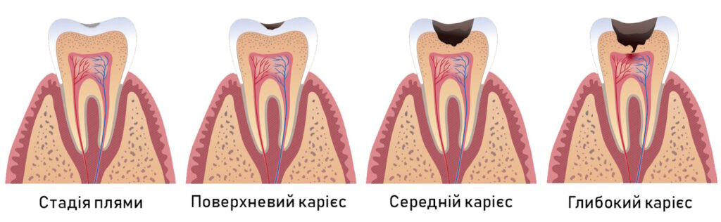 стадии кариеса
