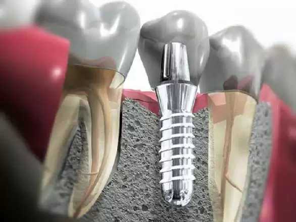 entalnie_implantati1 entalnie_implantati1