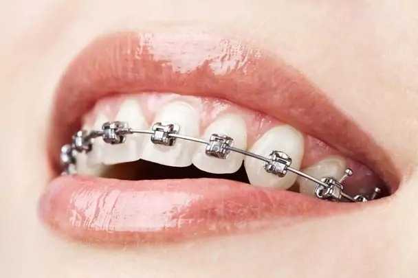 stock photo teeth with braces