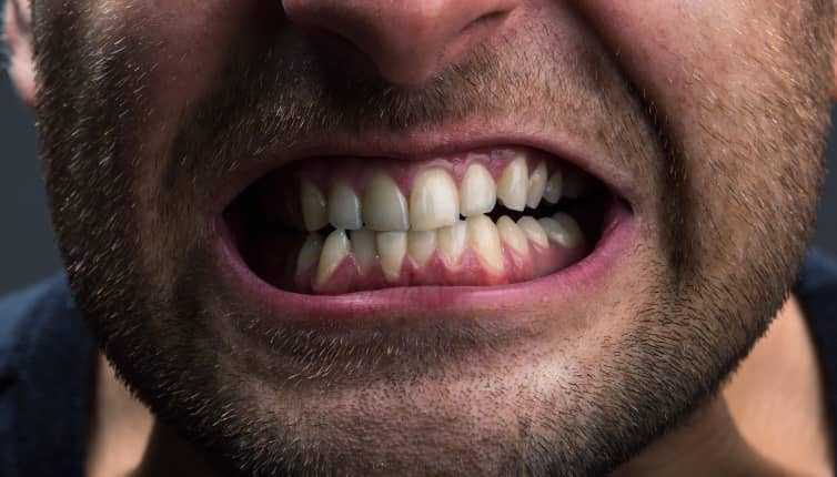 Bruxism