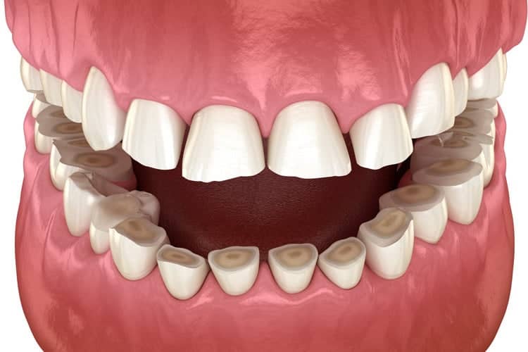 Tooth Destruction from Bruxism