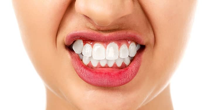 Bruxism: Understanding Teeth Grinding and Clenching