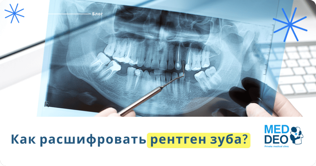 Как расшифровать рентген зуба?