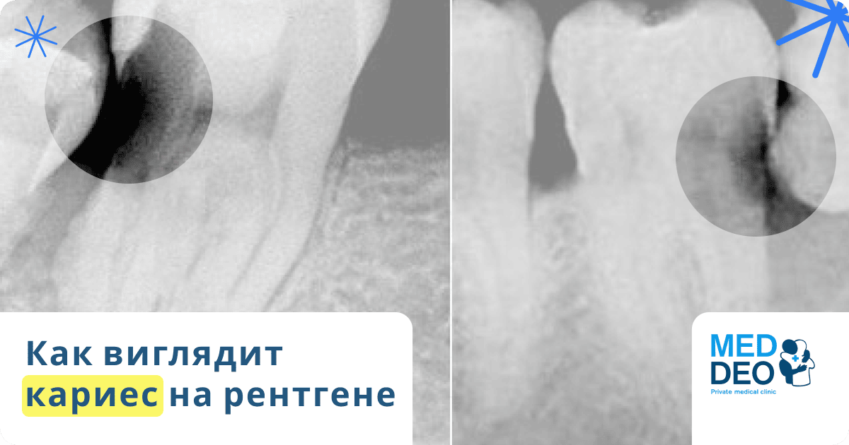 как выглядит кариес на рентгене