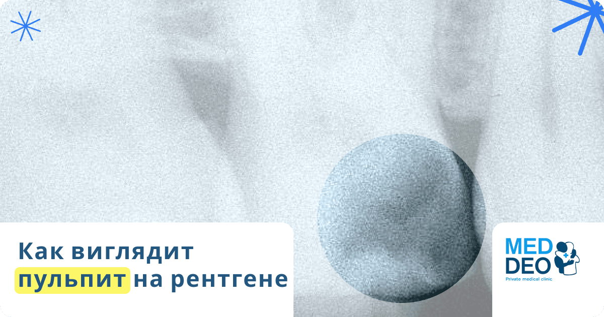 как выглядит пульпит на рентгене