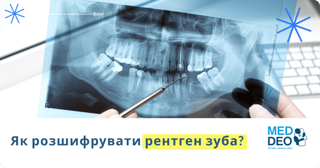 Як розшифрувати рентген зуба?