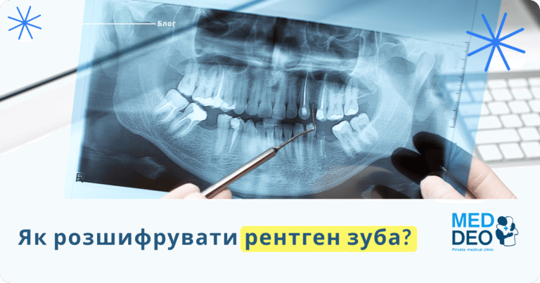 Як розшифрувати рентген зуба? yak rozshifruvati rentgen zuba