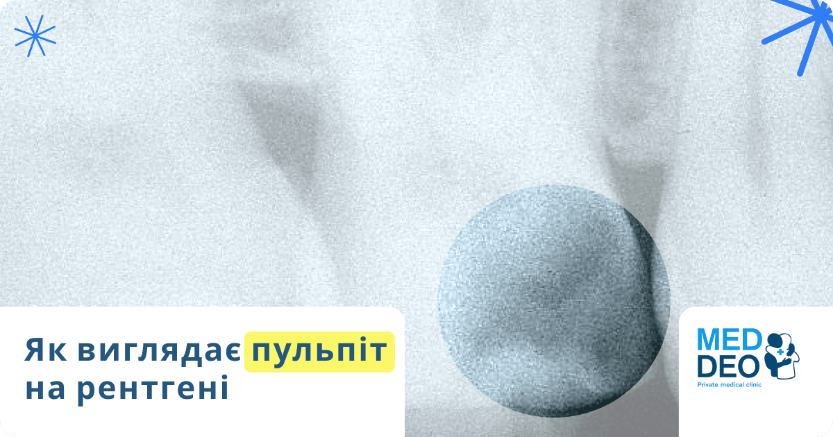 як виглядає пульпіт на рентгені