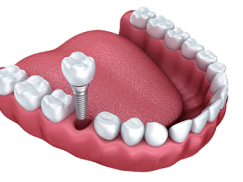 6-implant