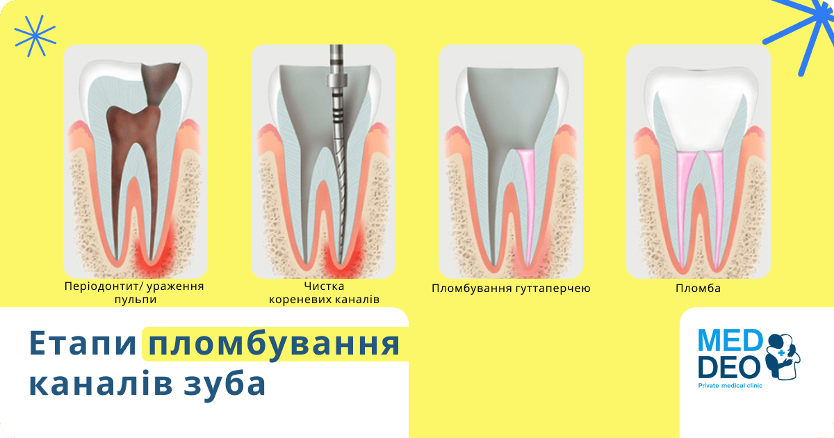 етапи пломбування каналів зуба