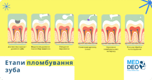 етапи пломбування зубів