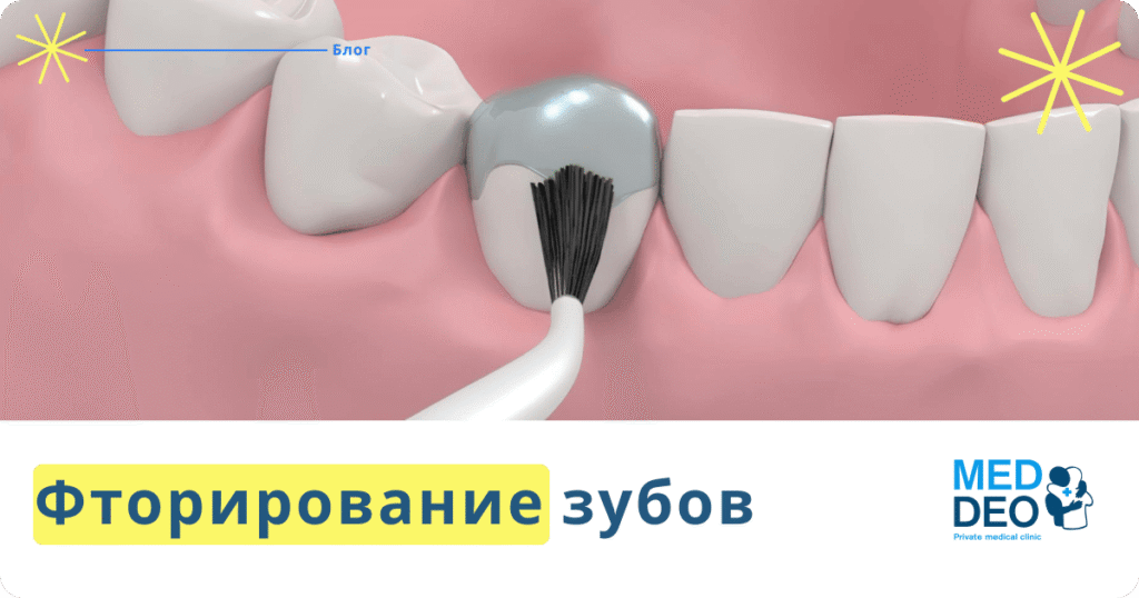 Ftorirovanie zubov_RUS Фторирование зубов