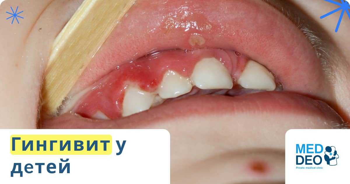 как выглядит гингивит у детей