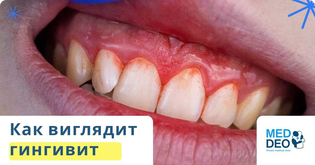 как выглядит гингивит