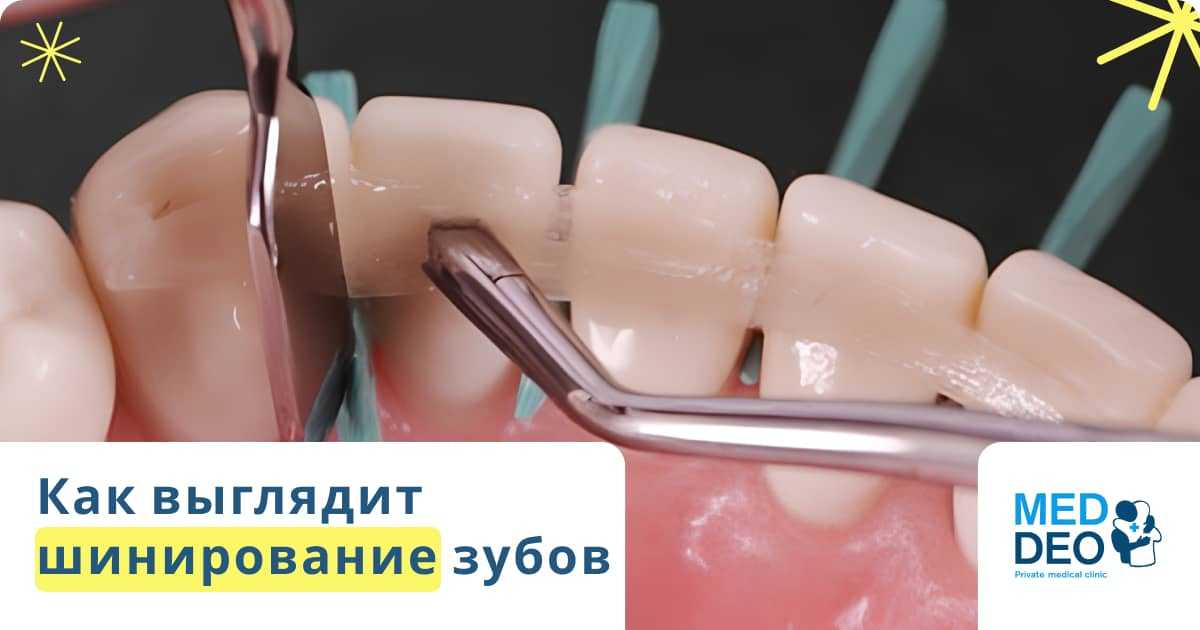 как выглядит шинирование зубов