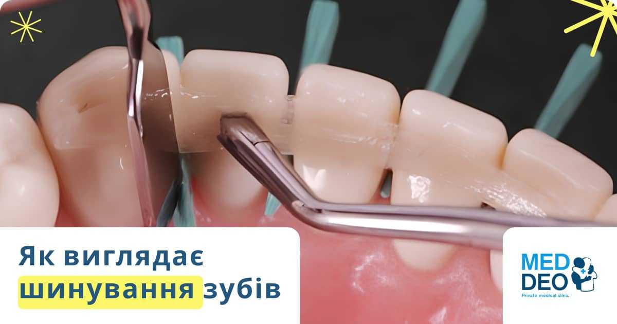 як виглядає шинування зубів