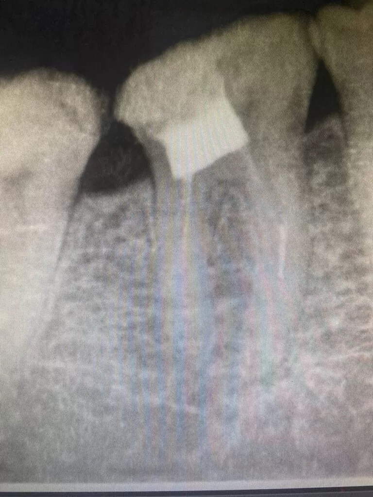 izvlechenie slomannogo instrumenta iz kornevogo kanala 768×1024