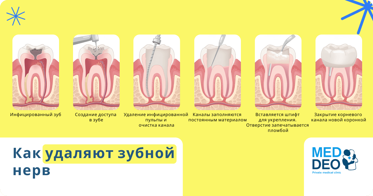 как удаляют зубной нерв