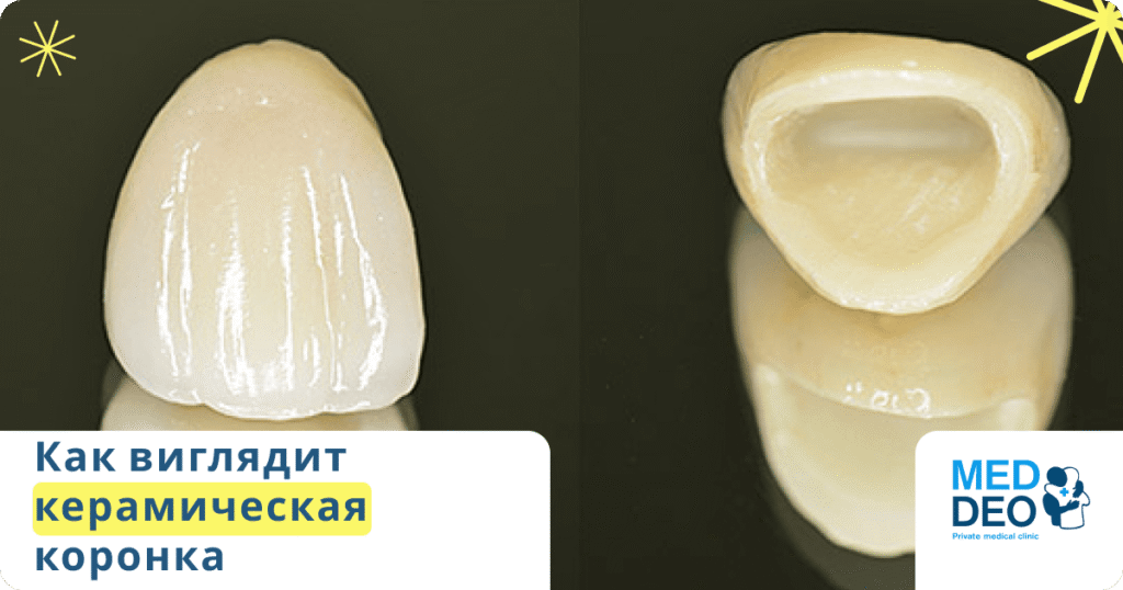 как выглядит керамическая коронка