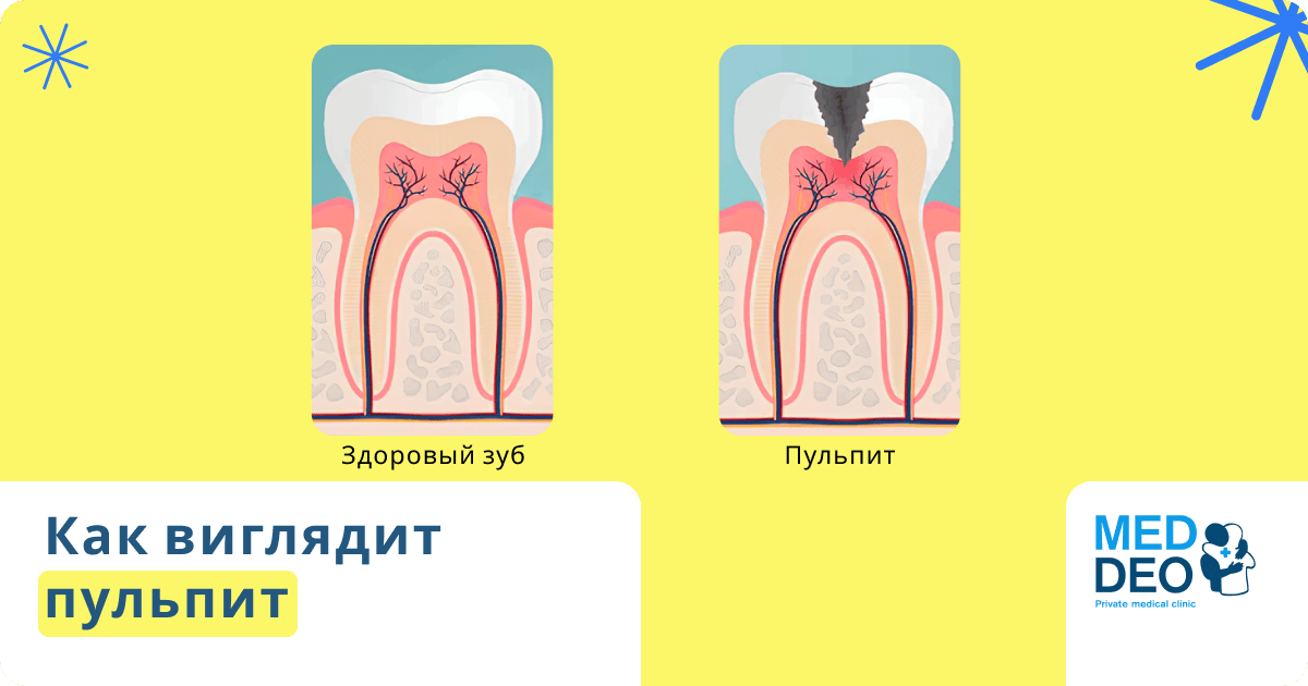 как выглядит пульпит