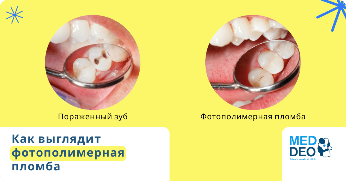 как выглядит фотополимерная пломба