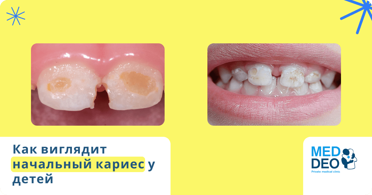 как выглядит начальный кариес у ребенка