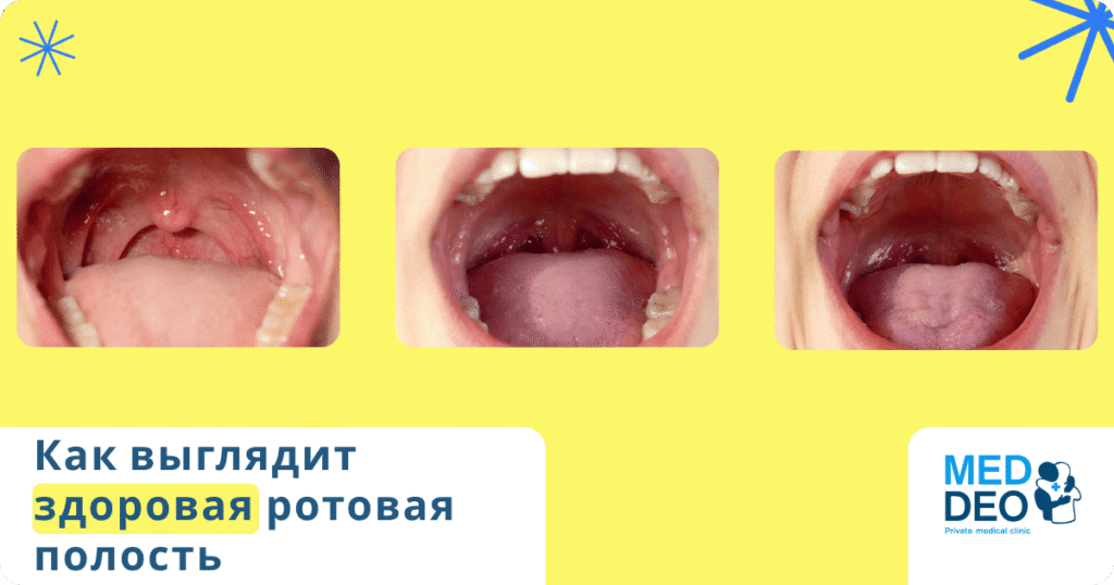как выглядит здоровая полость рта