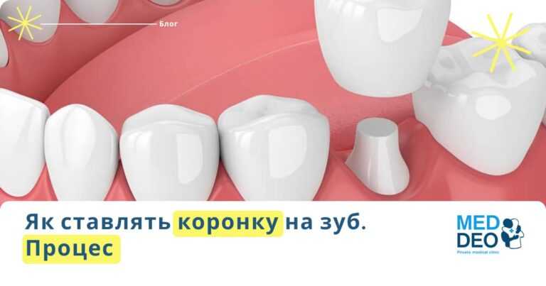 Як ставлять коронки на зуби koronki na zub
