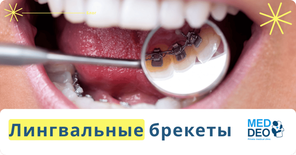 main image_Lingvalnye brekety_RUS Лингвальные брекеты