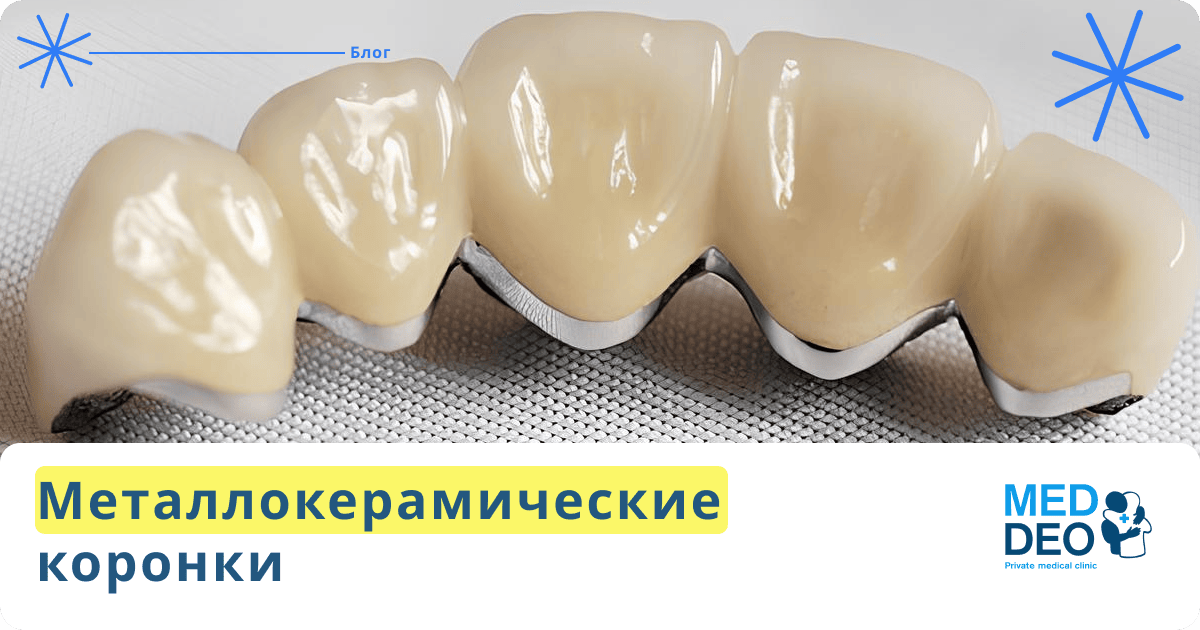 Металлокерамическая коронка