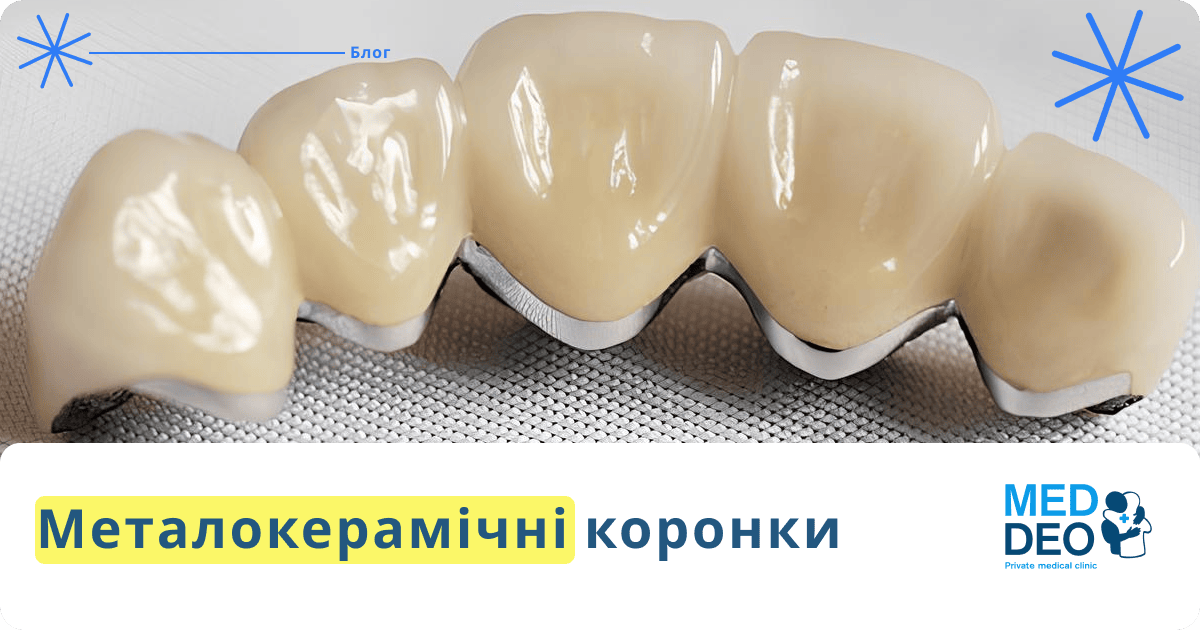 Металокерамічна коронка