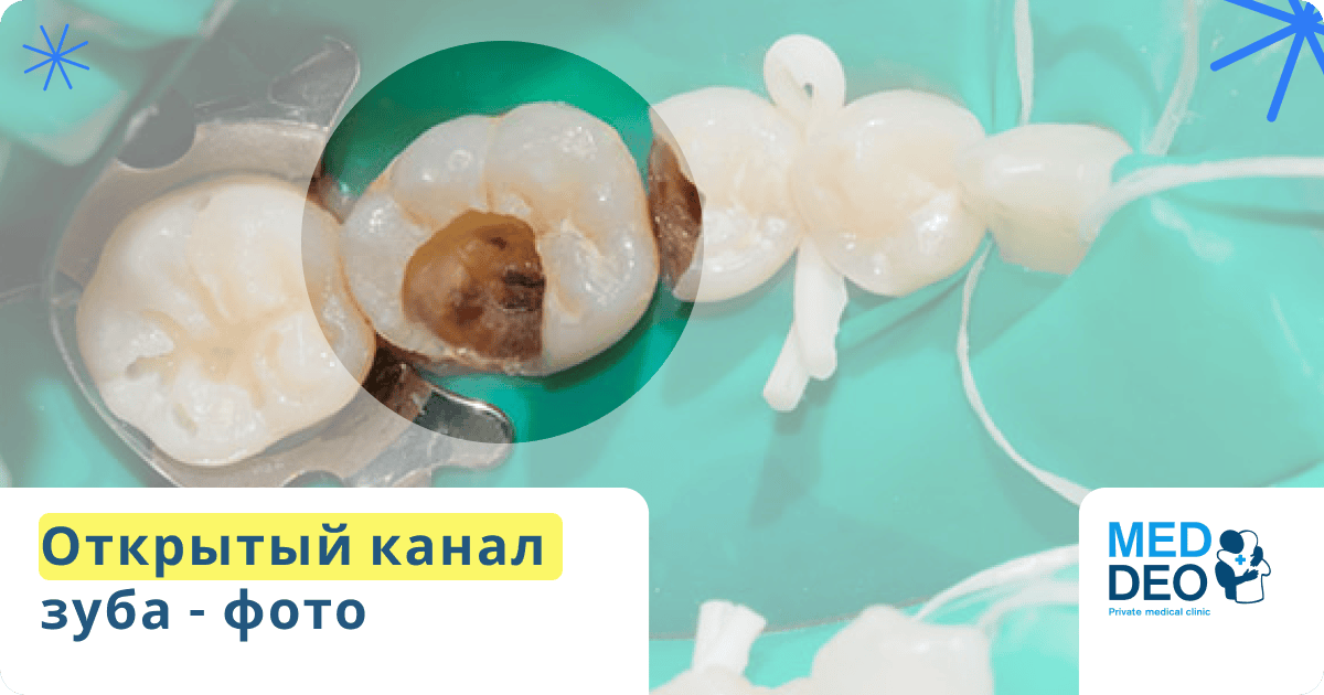 открытый канал зуба