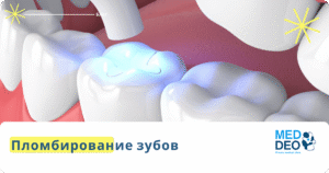 пломбирование зуба