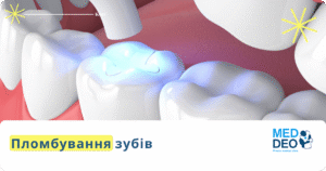plombuvannya zubiv пломбування зубів