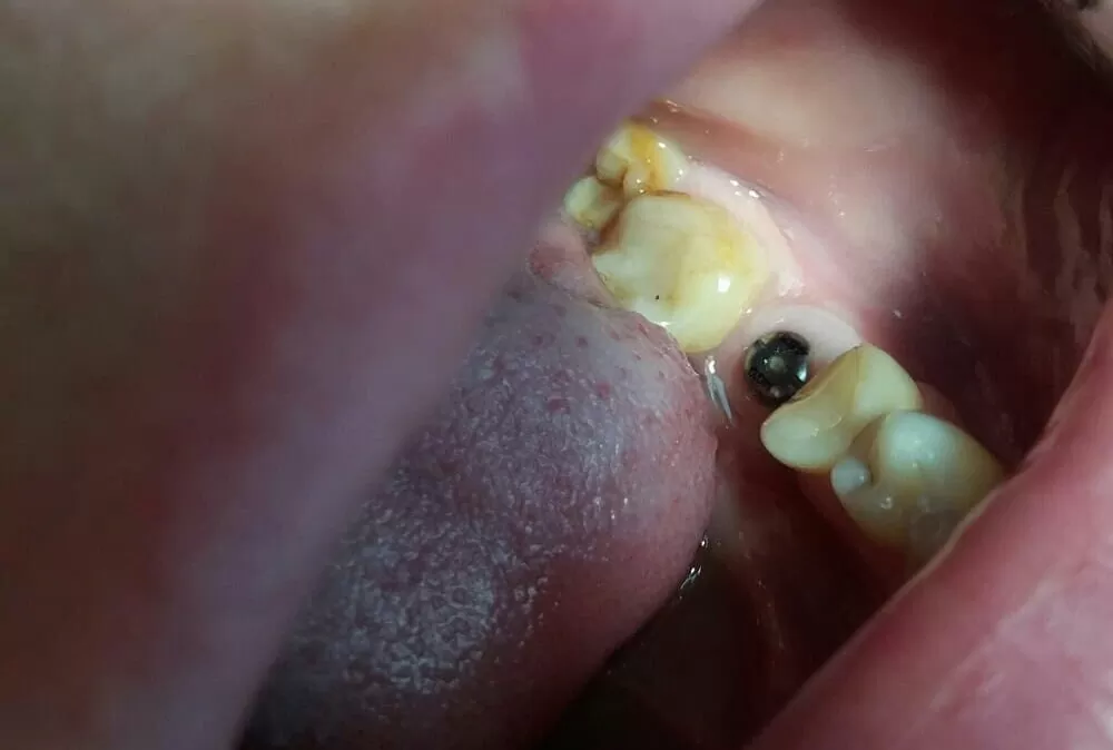 protezuvannya na implant 36 zuba