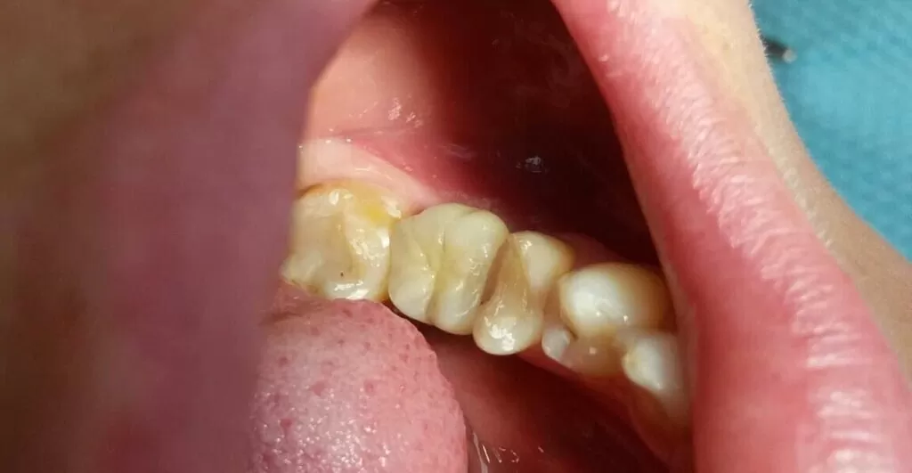 protezuvannya na implant 36 zuba2 1024×531