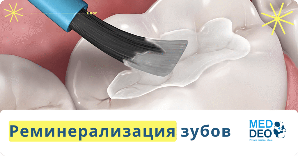 Реминерализация зубов