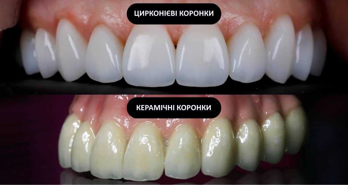 як виглядають цирконієві коронки на зубах