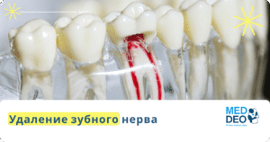 удаление зубного нерва