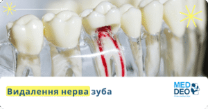 видалення нерва зуба