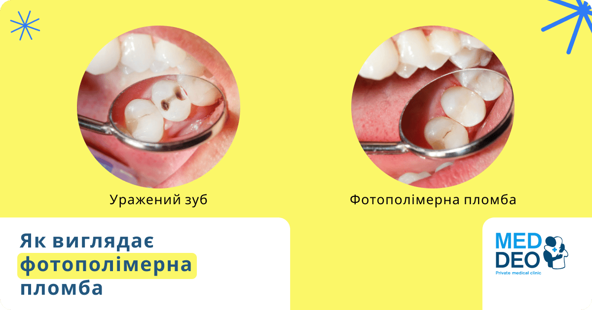 як виглядає фотополімерна пломба
