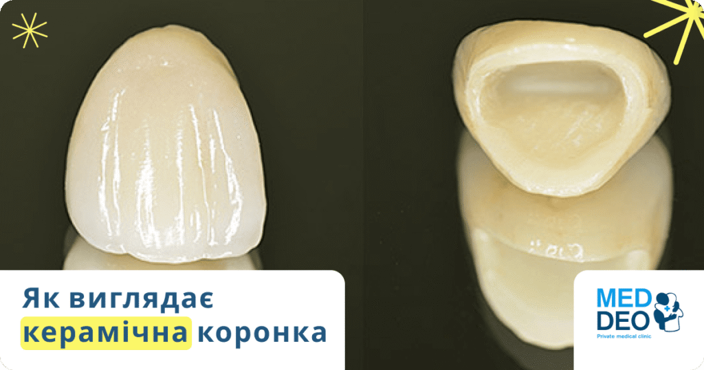 як виглядає керамічна коронка