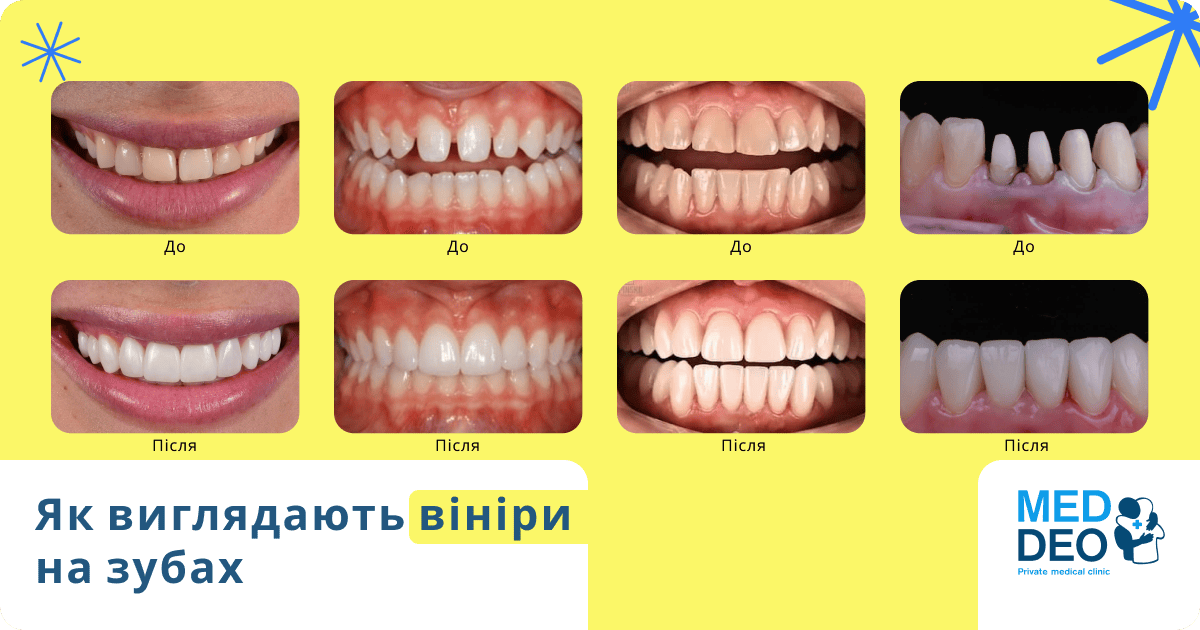 як виглядають вініри на зубах
