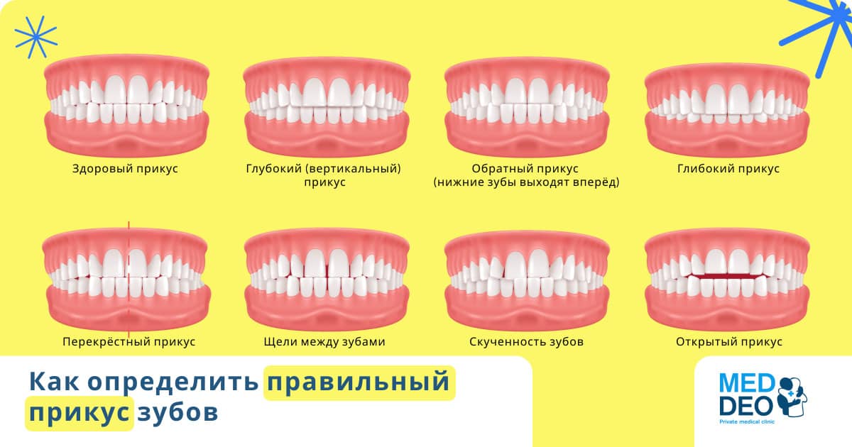 как определить правильный прикус зубов
