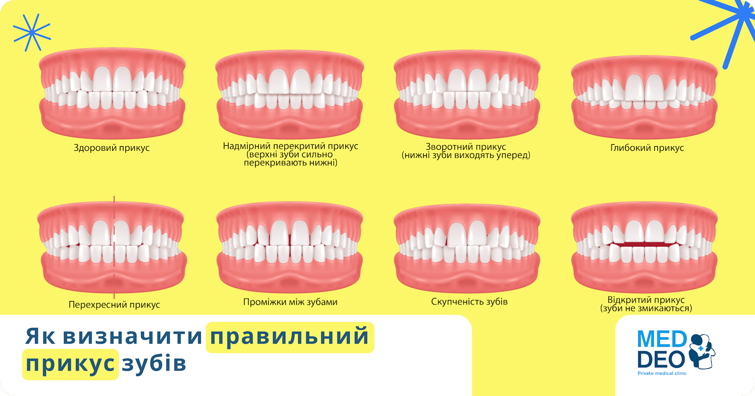 Як визначити правильний прикус зубів