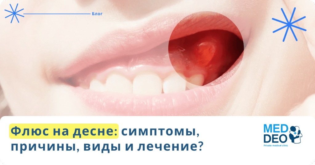Флюс на десне: симптомы, причины, виды и лечение?