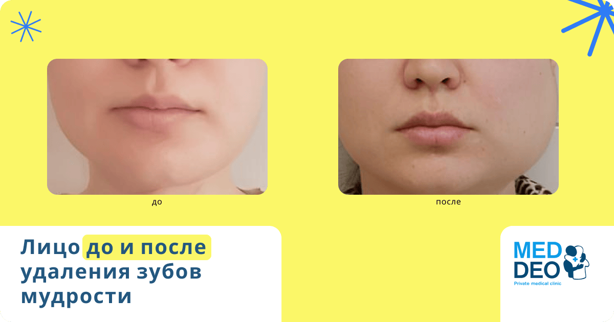 Осложнения после удаления зуба мудрости 3 лицо до и после удаления зуба мудрости