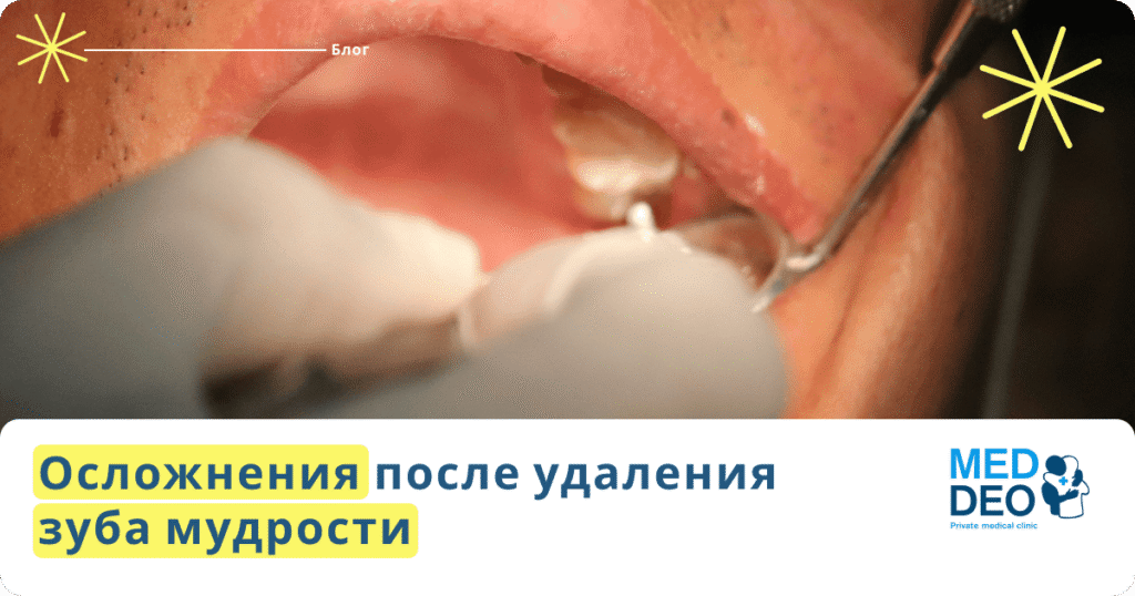 Осложнения после удаления зуба мудрости