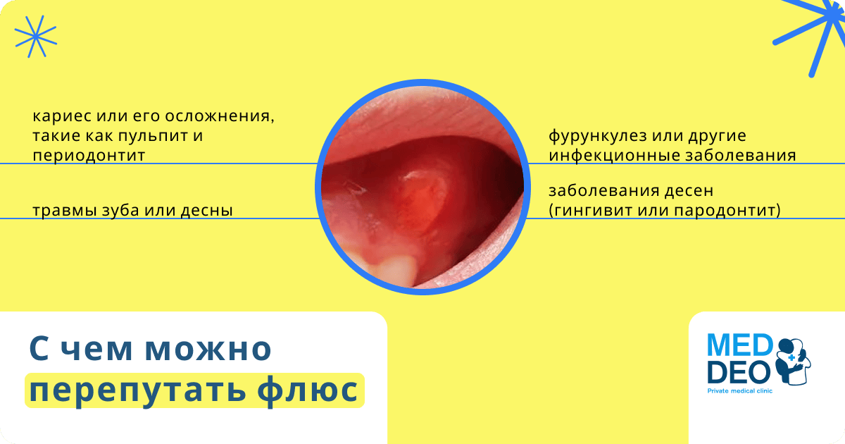 с чем можно перепутать флюс