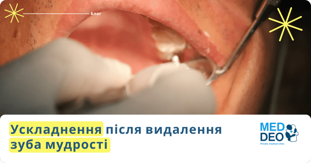 Ускладнення після видалення зуба мудрості